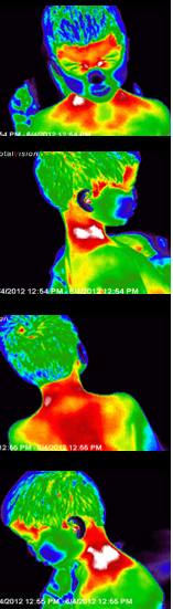 Thermal Images Before SWC - Child with Autism